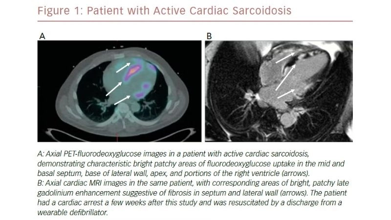 Sarcoid cardiomyopathy treatment managing heart inflammation effectively