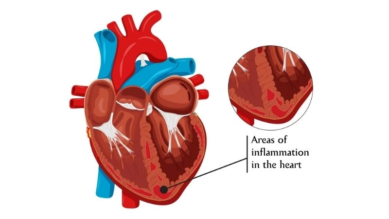 Sarcoidosis heart block electrical signal disruption in the heart