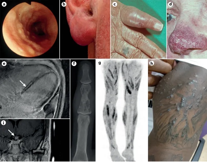 Cutaneous sarcoidosis visible in dermatological skin scan