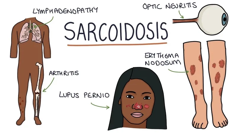 What is sarcoidosis explained in medical infographic