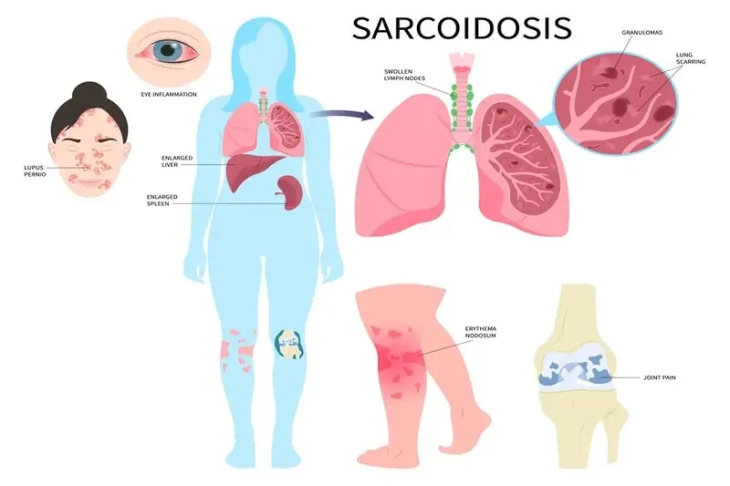 Sarcoidosis symptoms shown in clinical patient examination
