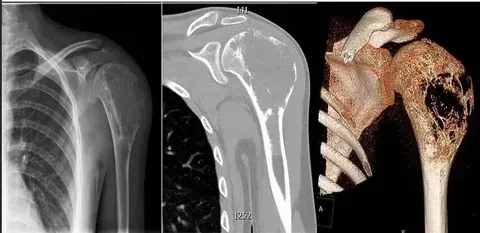 Sarcoma symptoms and early warning signs