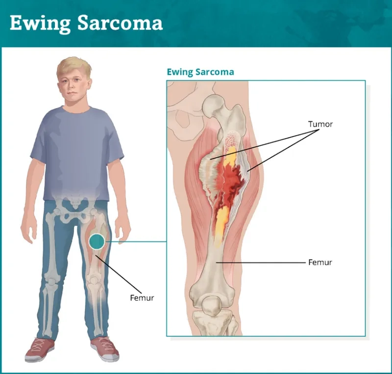 Osteosarcoma bone cancer in adolescents