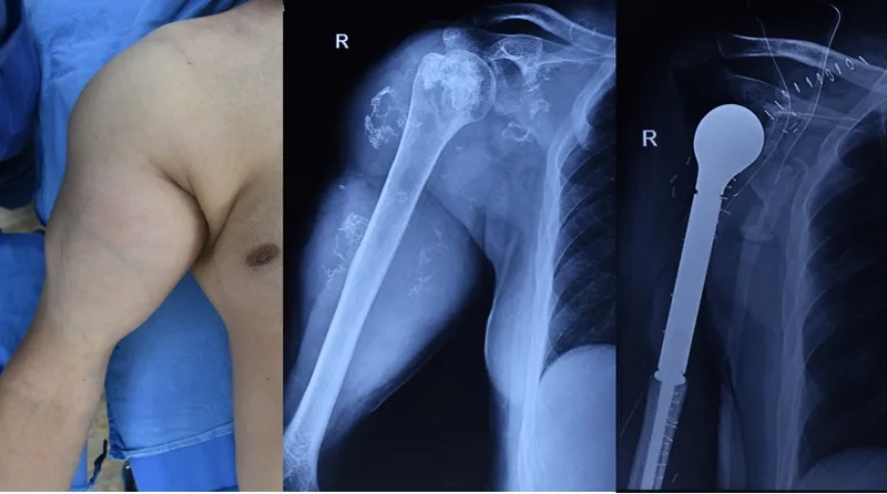 Soft tissue sarcoma diagnosis and care