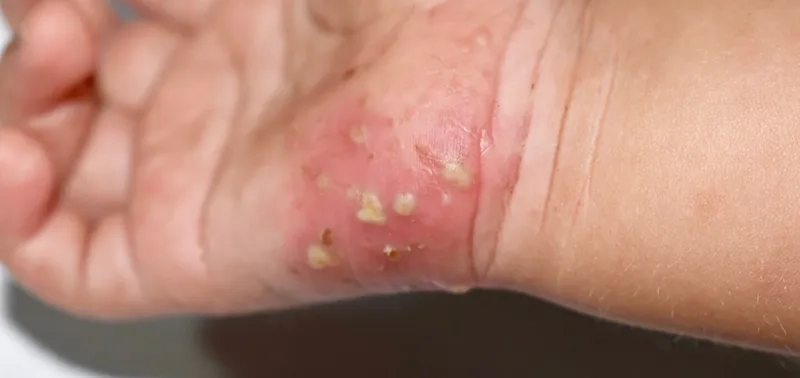 A collection of clinical pictures of scabies rashes