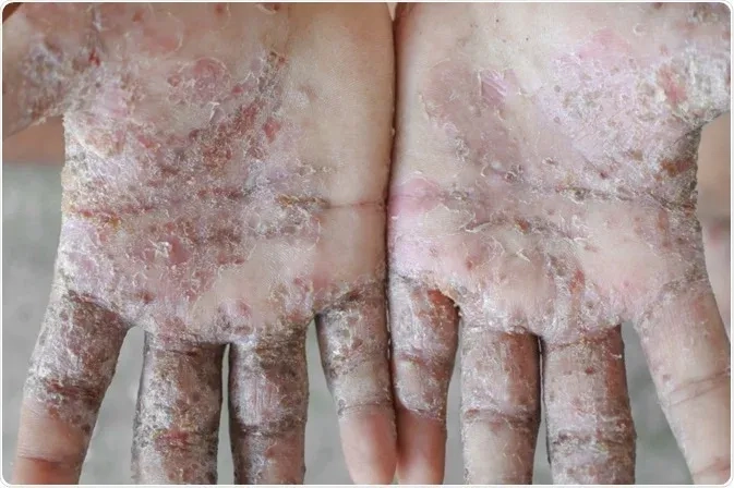 Applying permethrin cream for scabies to affected skin