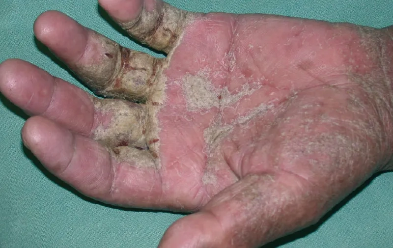 A microscopic image of the Sarcoptes scabies mites