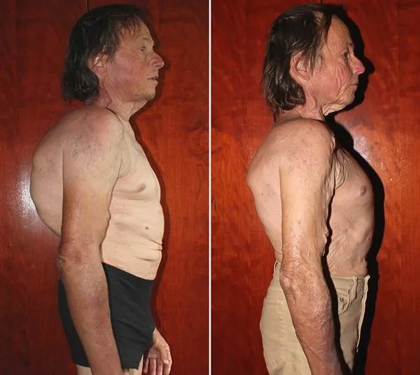 The progression of mild scoliosis over time