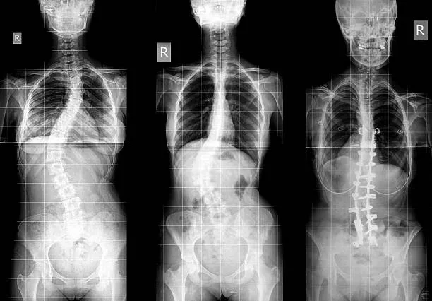 An X-ray showing the curve of adult scoliosis