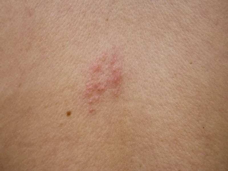 Common shingles vaccine side effects