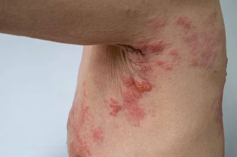 Detailed photos of shingles rash
