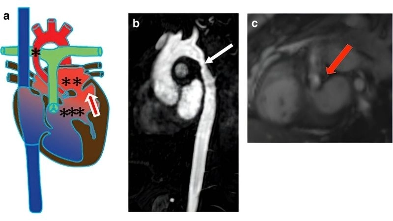 Shone's Complex symptoms warning signs of heart disease