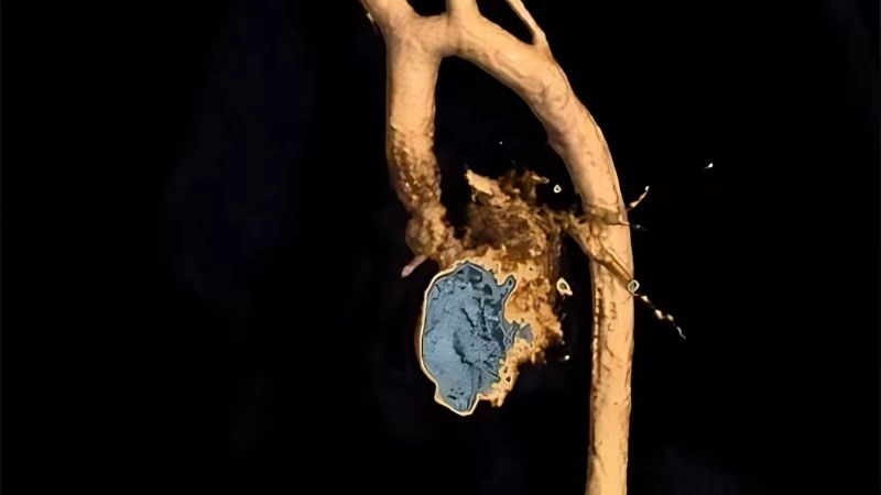 Shone's Complex surgery life saving cardiac surgical option