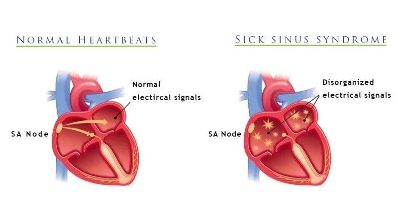 Sick sinus syndrome symptoms include dizziness fatigue and palpitations