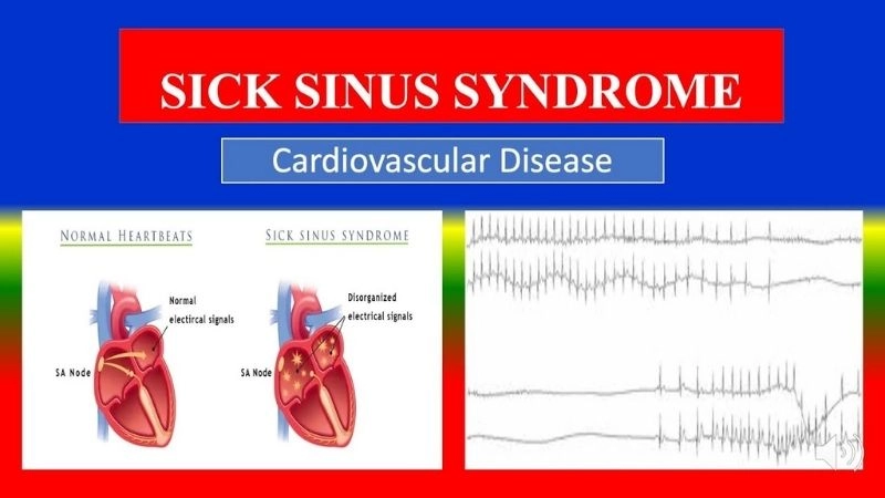 Sick sinus syndrome diagnosis uses ECG and monitoring tests