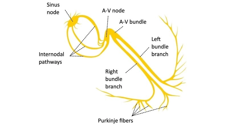 Tachy-brady syndrome combines fast and slow heart rhythms