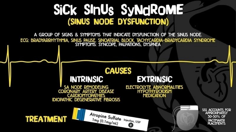 Sinus node dysfunction affects the heart’s natural pacemaker