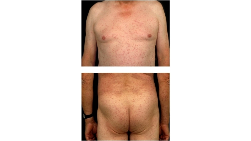 Sindbis Fever control by Sindbis fever prevention