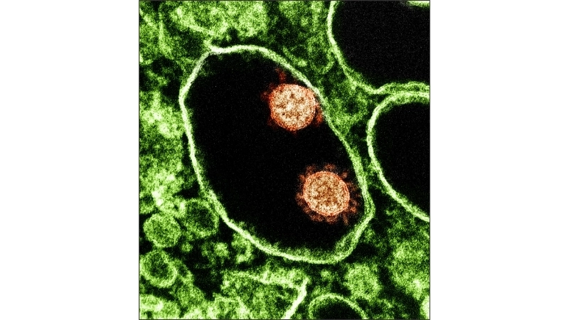 Sindbis Fever spread by Sindbis virus mosquito