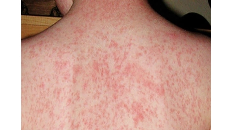 Sindbis Fever test with Sindbis virus diagnosis