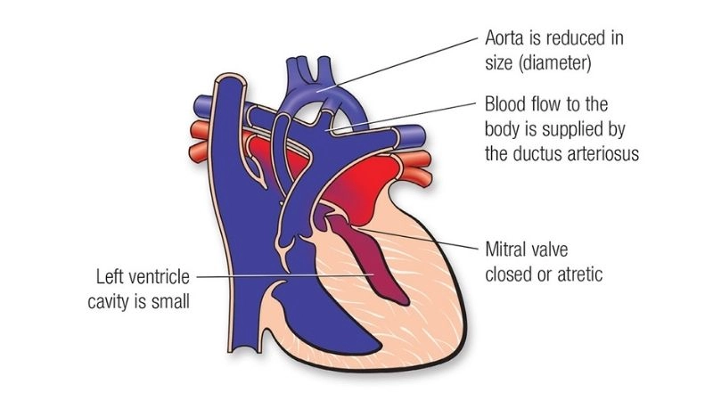 Single ventricle surgery procedures and recovery explained