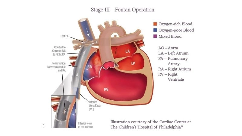 Fontan procedure role in single ventricle repair