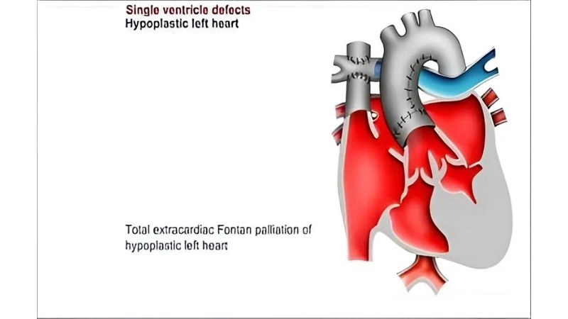 Single ventricle defects in adults management and care