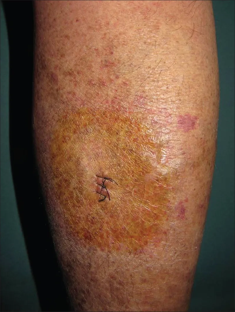 The role of SSA/SSB antibodies in diagnosis