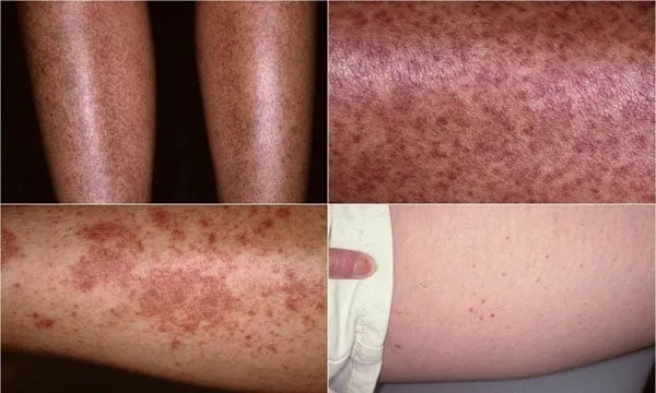 A graphic showing how this autoimmune disease works