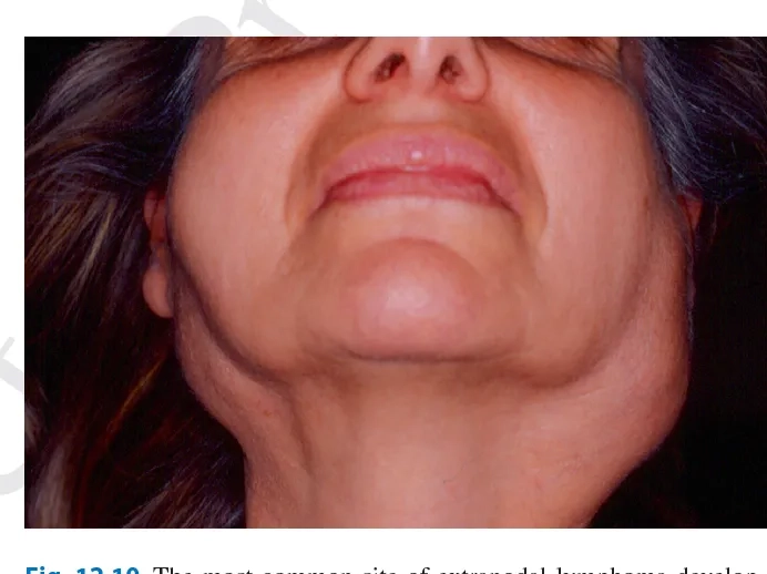 A patient using eye drops for dry eyes