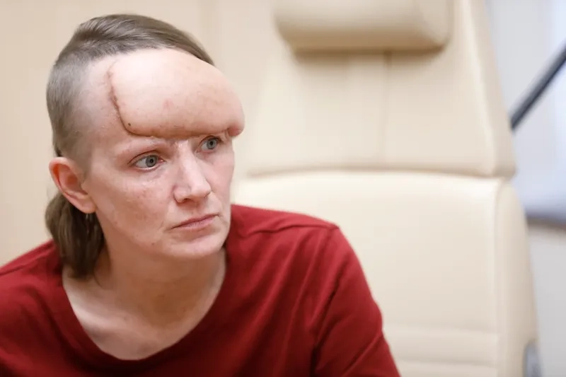 A diagram showing the different melanoma stages