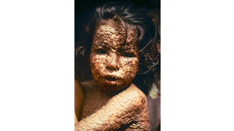 Discover smallpox vaccine for smallpox