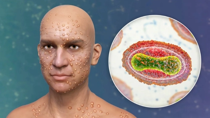 Modern smallpox treatment against smallpox