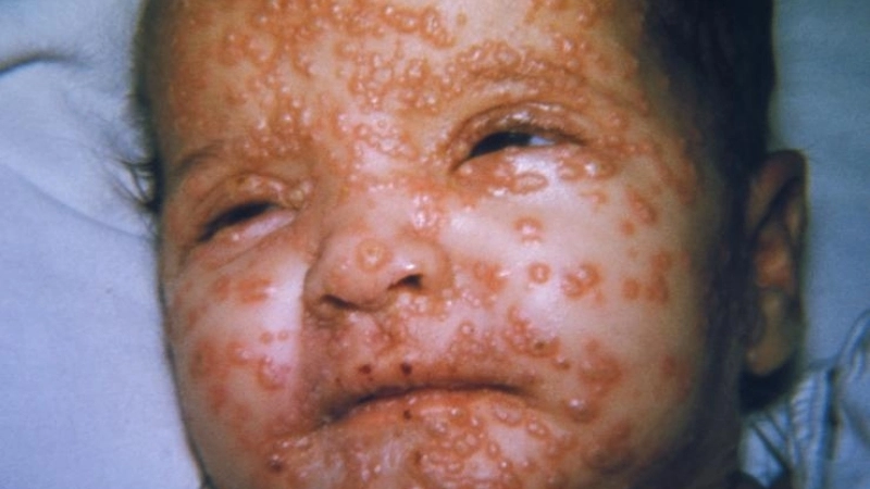 Smallpox virus remains cause of smallpox