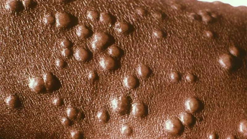 Seeking smallpox cure for smallpox relief