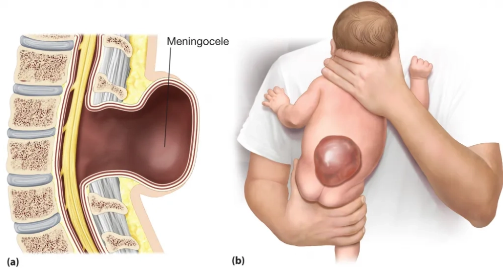 The range of spina bifida symptoms