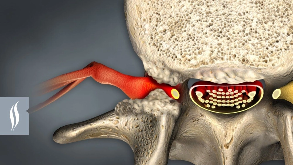An illustration of spinal stenosis surgery