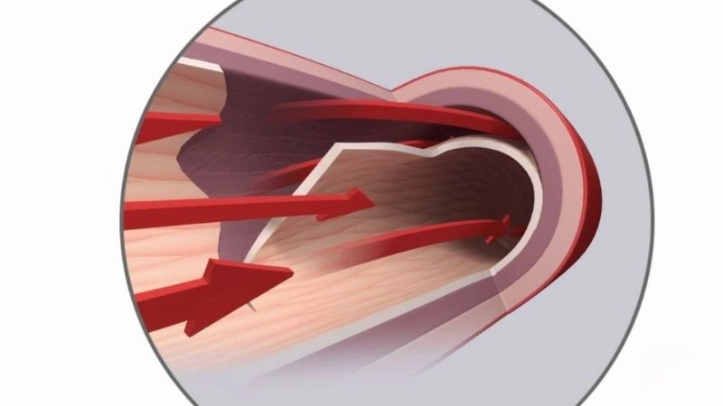 Spontaneous coronary artery dissection in women