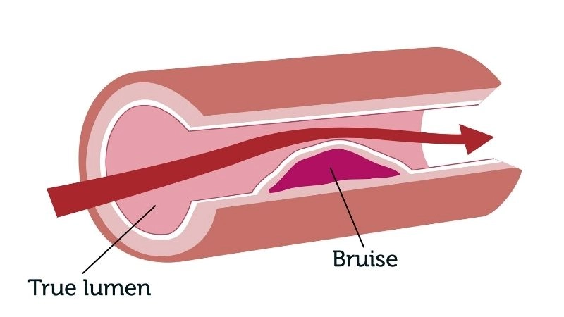 Common hidden triggers and causes of SCAD