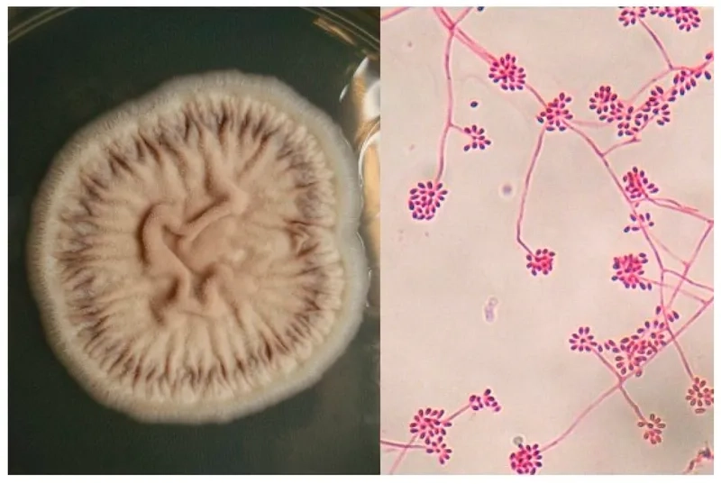 A skin lesion from cutaneous sporotrichosis