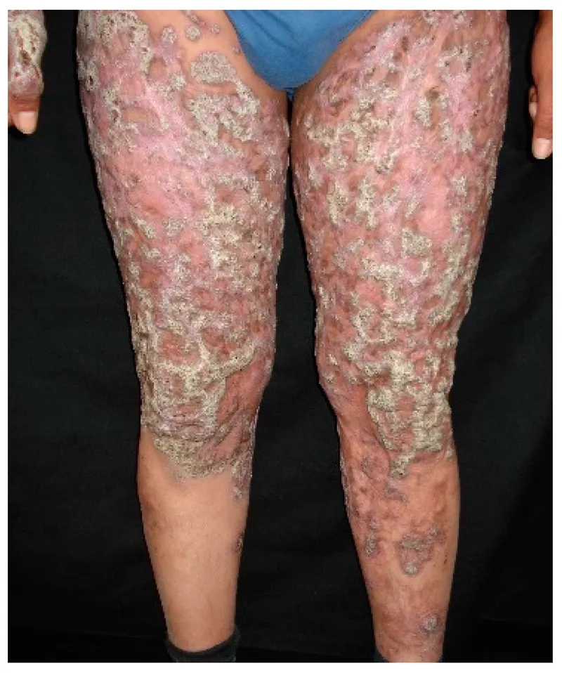 An arm showing common sporotrichosis symptoms