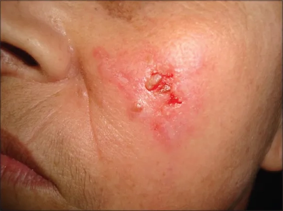 A close-up of a fungal infection from thorns