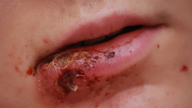 A medical illustration explaining what is MRSA