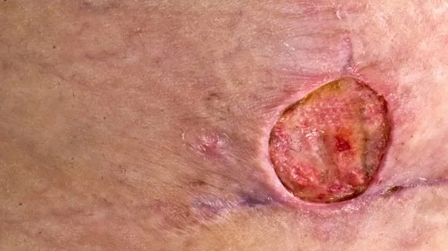 Close-up showing common MRSA symptoms on the skin