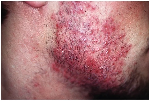 Doctor discussing MRSA treatment with a patient