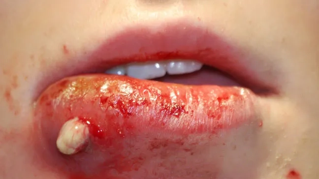 Infographic detailing staph infection symptoms