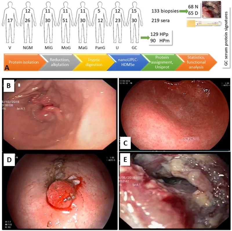 Advanced stomach cancer treatment options