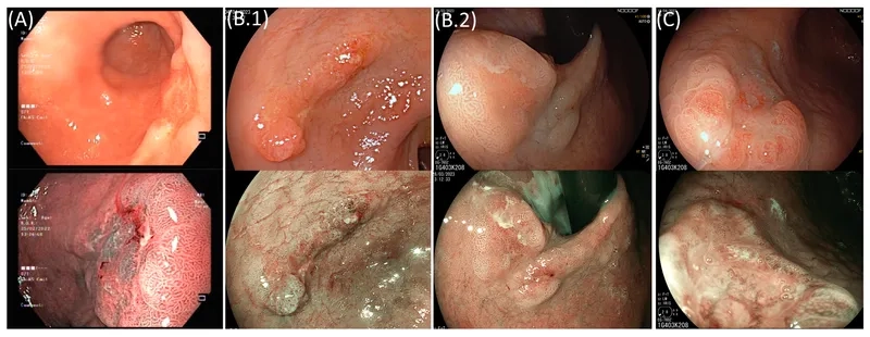 H pylori infection and its link to stomach issues