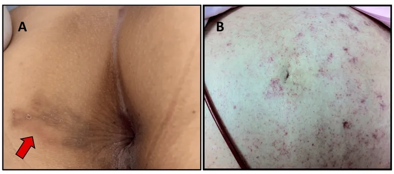 The role of ivermectin for strongyloidiasis treatment