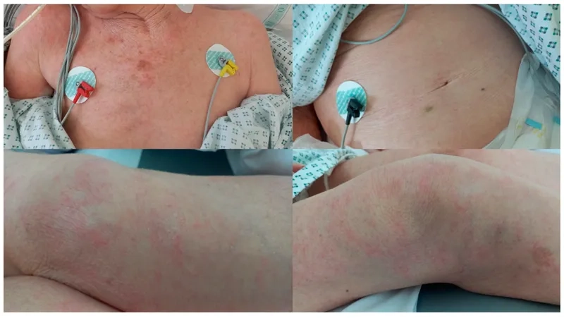 Lab procedures for the diagnosis of strongyloidiasis